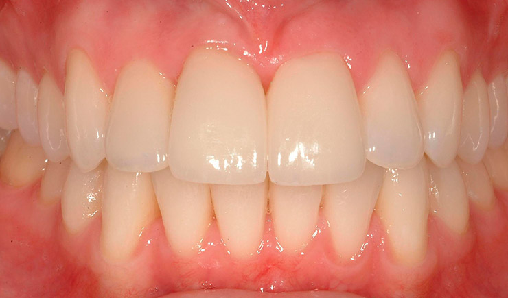 Skallfasetter - Tannlege Svendsrud