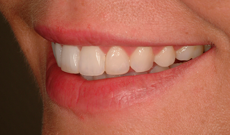 Smilet etter Tannreguleringen - Tannlege Erik Svendsrud